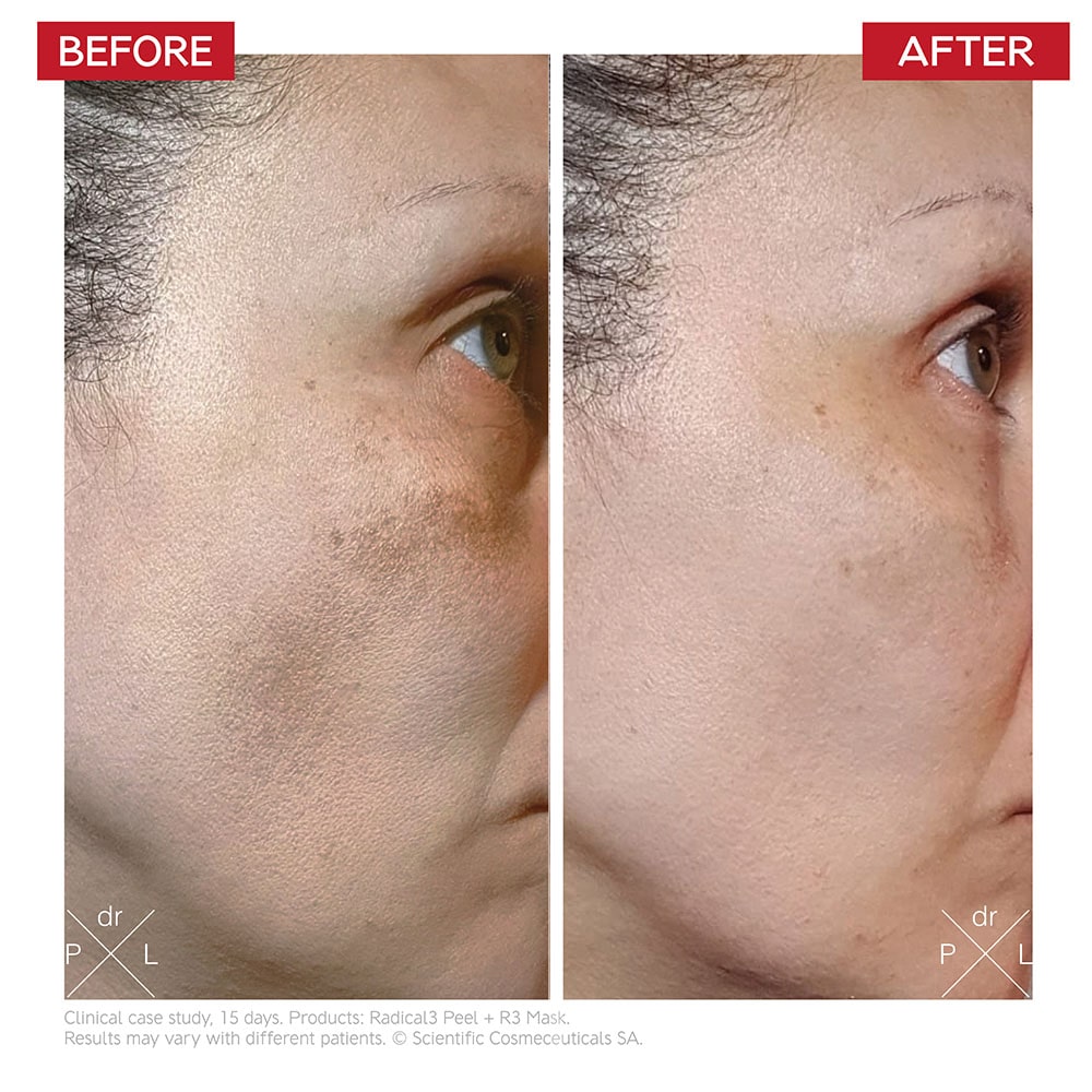 DR. LEVY Radical3 Reboot Pro Peel